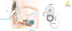 electrode-cochlear-implant