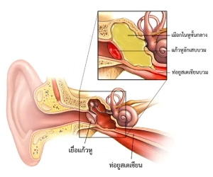 tinnitus and hearing loss หู อักเสบติดเชื้อ